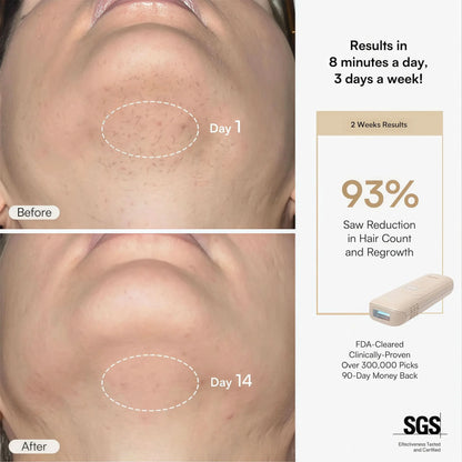 NAMI IPL Hair Removal  Device